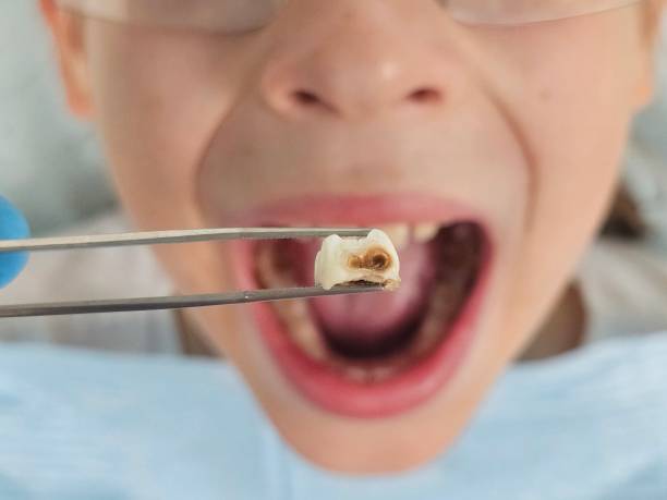 Best Urgent Tooth Repair  in Center, TX